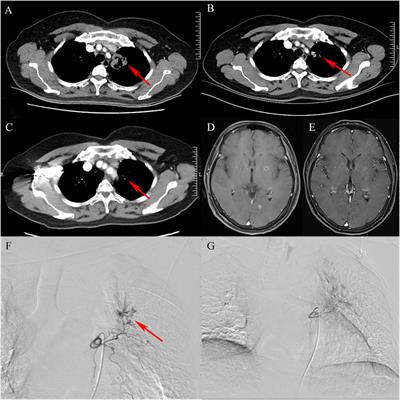 Bevacizumab loaded CalliSpheres® bronchial arterial chemoembolization combined with immunotherapy and targeted therapy for advanced lung adenocarcinoma